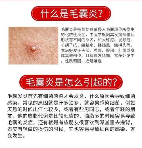 毛囊炎马拉色菌箹头皮后脑勺背部腋下胸口四肢去除皮囊l炎祛痘痘皮肤