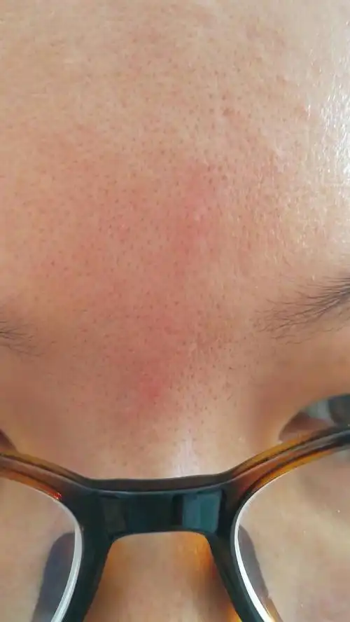 额头上的是毛孔还是黑头,怎么解决