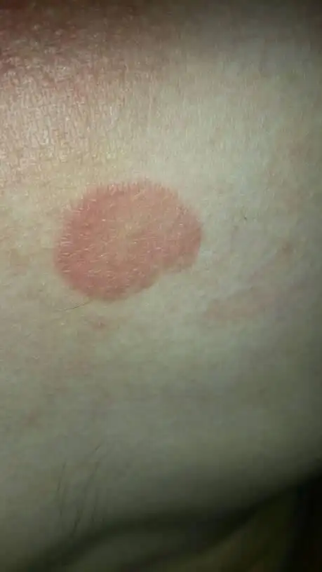 2014-01-09 李玉林 医师 长了一块像胎记的疤,越长越大,这是皮肤病吗?