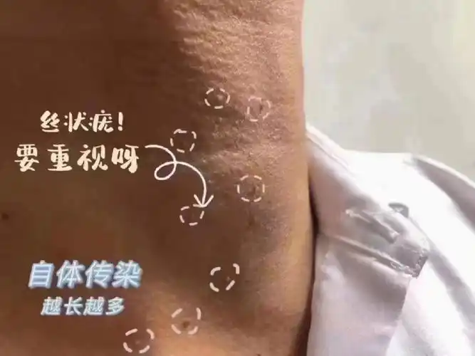 脖子上的"小肉丁",学名叫丝状疣 是hpv病毒感染,具有传染性