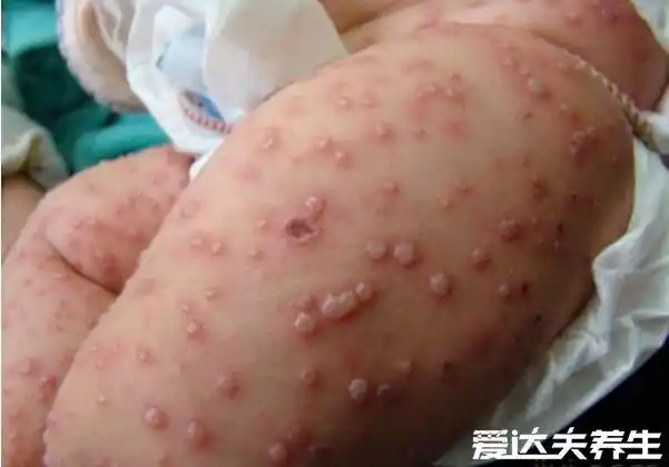 水痘早期图片大全出现水痘不可怕10天左右可