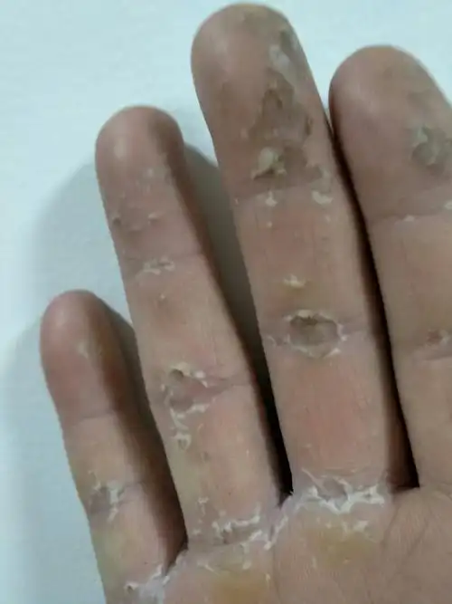 这种癣咋治疗,哪里能治好?