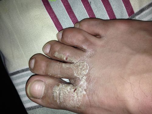 脚板心痒脚气苗夫人草本药膏软膏抑菌止痒皮肤瘙痒外用祛廯清肤毒