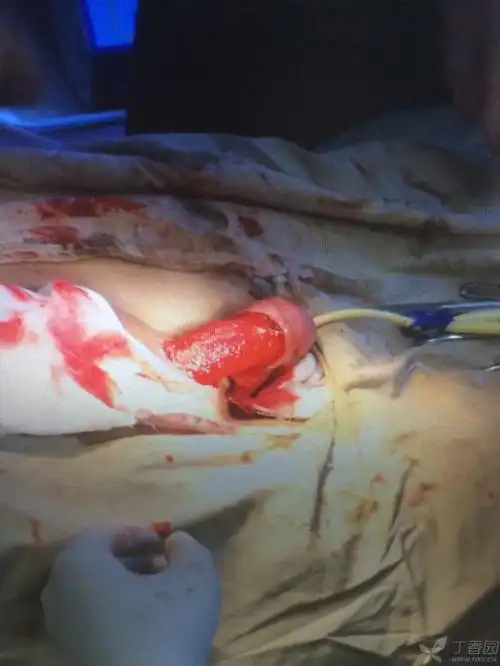 患者阴茎脱套伤,腹部皮瓣修复