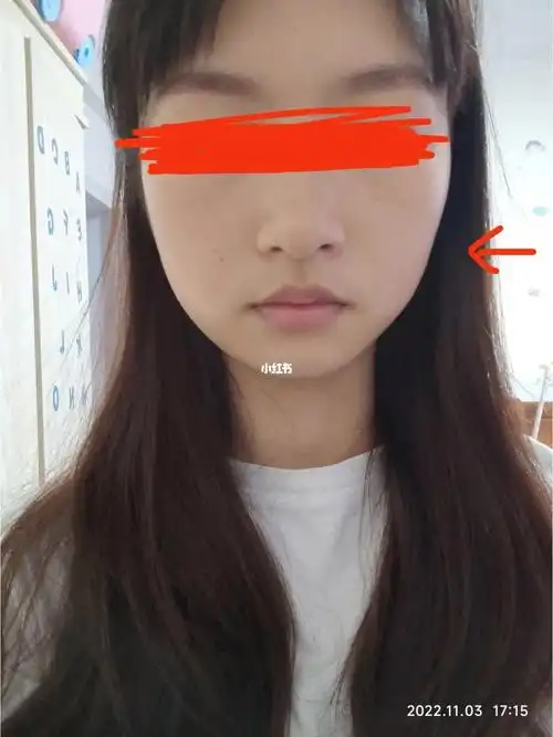 拔完智齿脸凹陷垮了