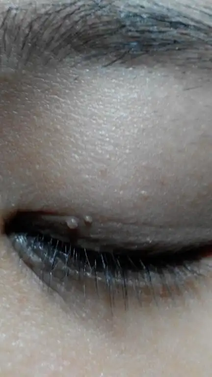 眼睛长了小肉粒现在太阳穴和眼睛下面也慢慢长了不像脂肪粒那