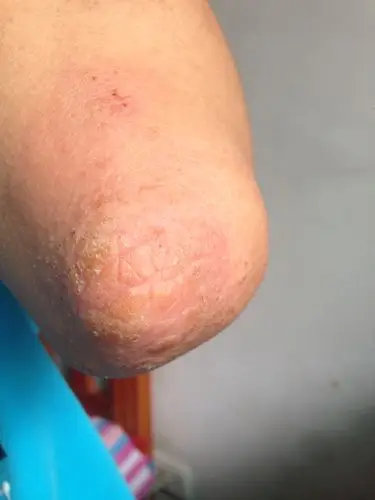 我的手肘一直这样,并且很痒.好几年了,这是怎么回事? 该怎么办?
