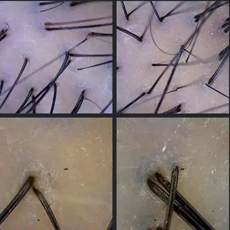 头发,你为什么要做毛囊检测?