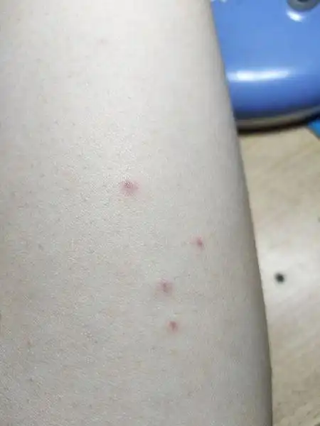 皮疹  追问 会自己消失吧,就长了五六个点,没必要去皮肤科吧 追答 有