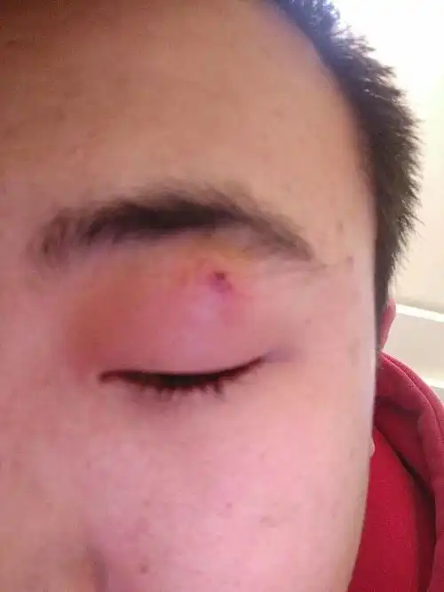 眼皮上长了一个青春痘,早起都肿了,让我给挤了,然后就更肿了,在线急等