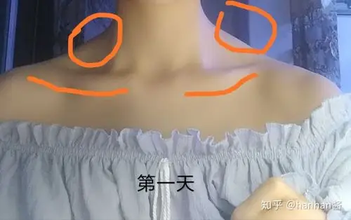 坚持一个月的周六野斜方肌操可以消除斜方肌吗?