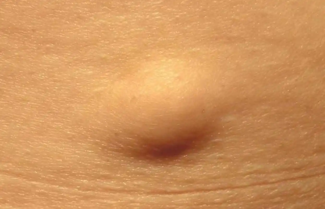 35岁女子,后背长了一个包块,洗澡的时候挠出血,到