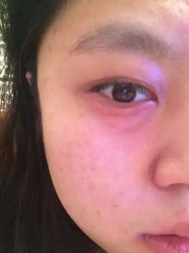 眼睛会明显感觉下眼袋肿大了.什么情况是淋巴吗