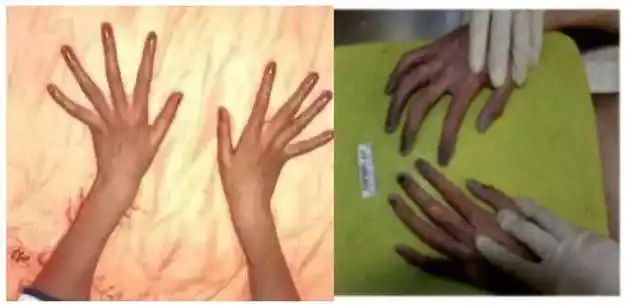 儿科医生教你通过观察孩子的手指,判断孩子是否健康