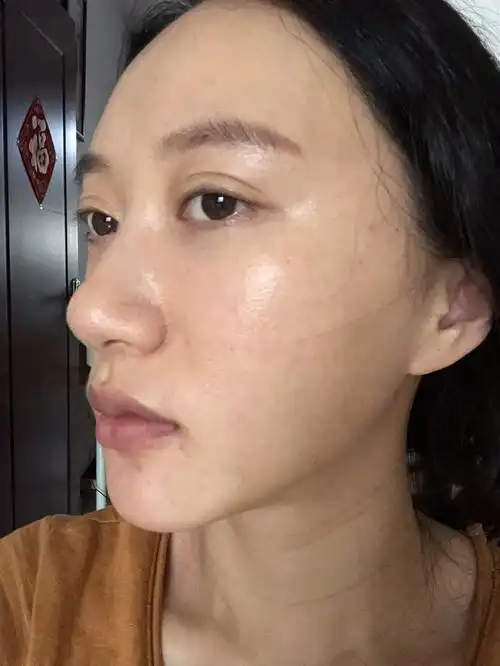 我是混合性皮肤.脸颊干,t区爱出油,嘴周围会长痘._圈子-新氧美容整形