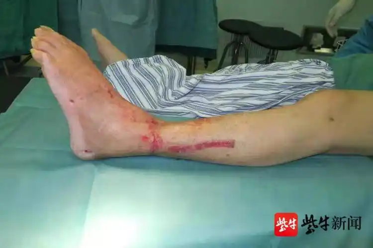 左脚卷进机器造成粉碎性骨折!断肢再植术为患者保命保肢