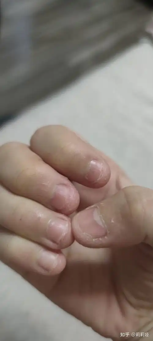 我今天26了,从小就爱咬指甲,试了很多方法都改不掉.是心理疾病吗.