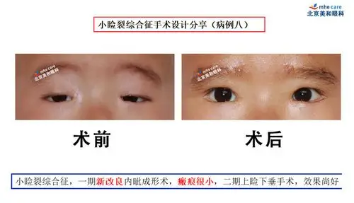 上睑下垂手术照片—精品课(四)