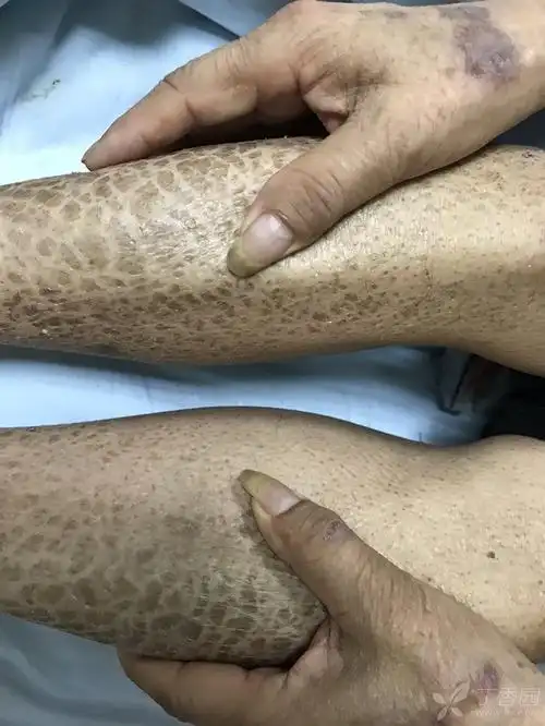 用鱼鳞描述的鱼鳞病