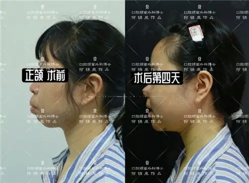 正颌骨手术千万别去做?那是因为你没有做到这几点!