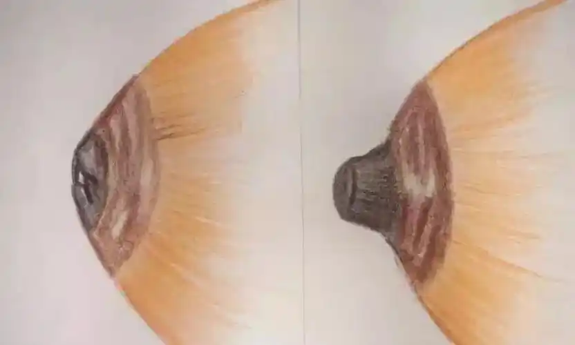 乳头内陷影响母乳喂养吗你想知道的都在这儿了