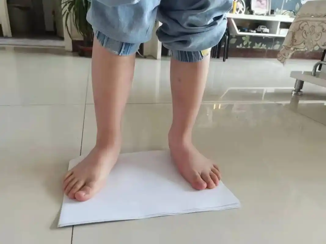 客户定制实例.5岁左右的孩子,如果有这样程度足外翻情况,是非 - 抖音