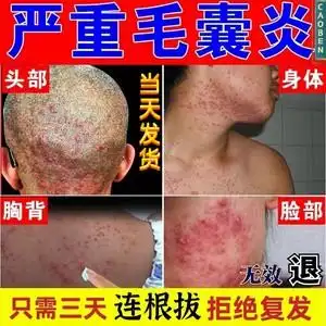 治疗头皮毛囊炎专用头部脖子前胸后背私处马拉色菌痘痘中药酊膏药