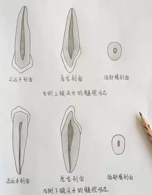 口解生 右侧上下颌尖牙的髓腔形态