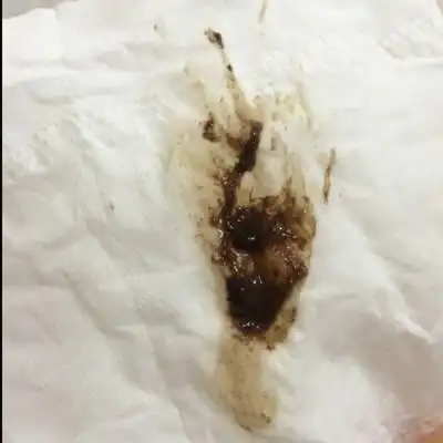 1号,现在偶尔会出现褐色分泌物,如图,请问正常吗,偶尔会很少,颜色较浅