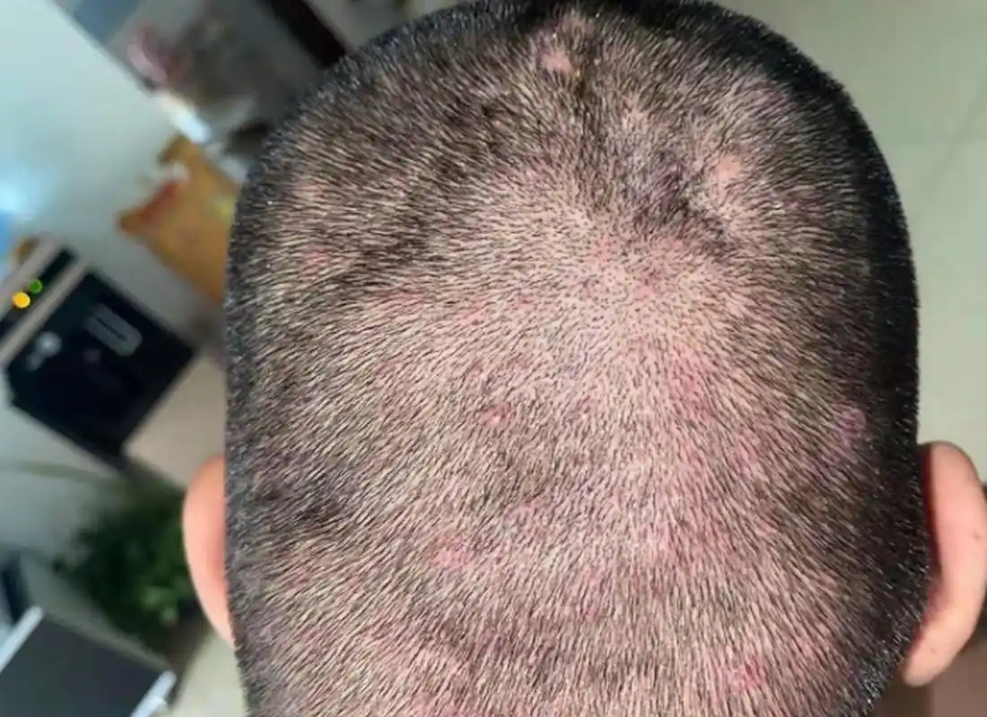 头上反复起毛囊炎和头皮爱出油有关系吗?