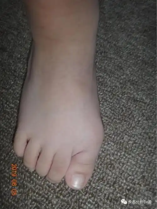 是的,在许多教科书里都有专门的一章,儿童青少年拇外翻.