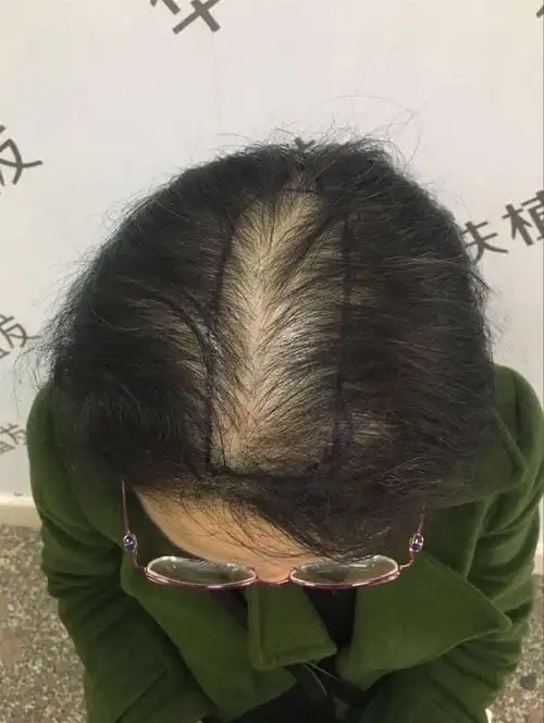 30岁女性脱发怎么办头顶已经开始漏头皮了需要植发吗植发后还会脱发吗