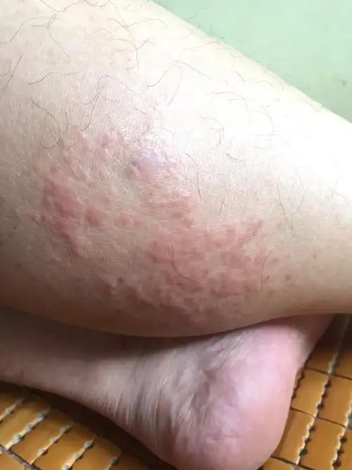 最近几天小腿上出现红斑无消退迹象摸起来有点硬发痒全身