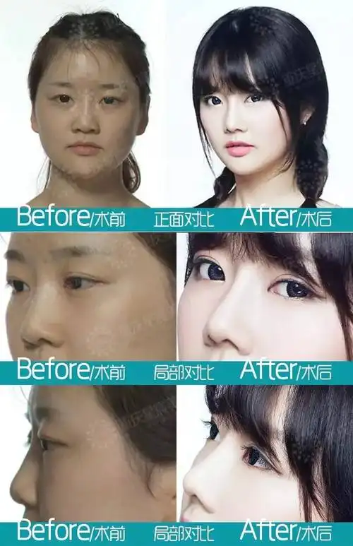 "塌鼻女孩"逆袭"清纯女神"!_重庆星宸美容医院