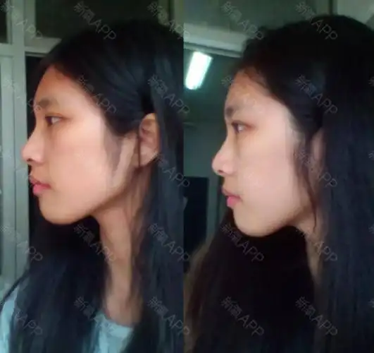 正能量骨性龅牙牙套前后侧面对比