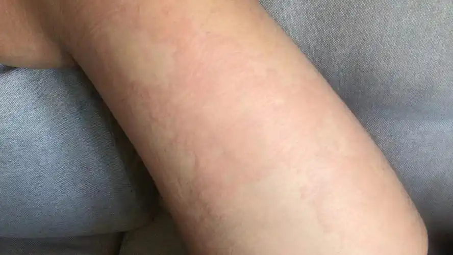 儿子的急性寻麻疹5天修复好了