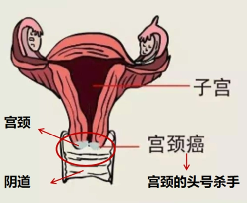 宫颈癌之警惕"小粉红"变身"红颜杀手"