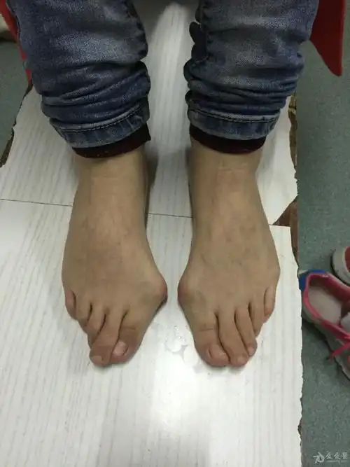 重度拇外翻求手术方案