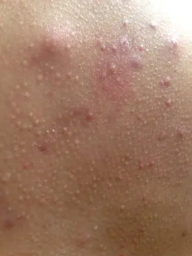 前胸后背都这样,怎么回事呢