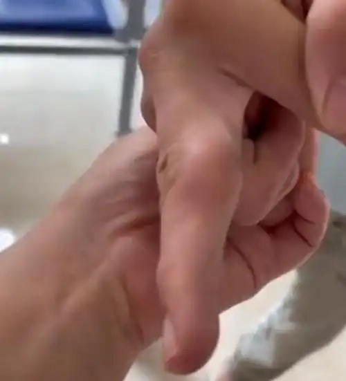 父母在外打工重庆14岁学生长期喝奶茶吃垃圾食品手指严重变形