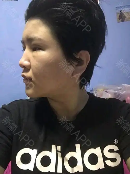 视觉酱自体脂肪全脸填充第15天美丽日记