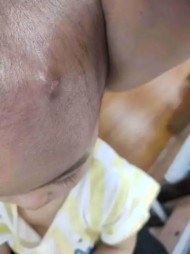 孩子头上长包,越来越大怎么回事?