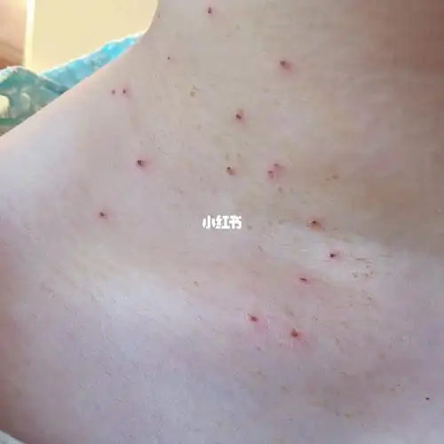 丝状疣最佳治疗方法(丝状疣用什么药膏一涂就掉)