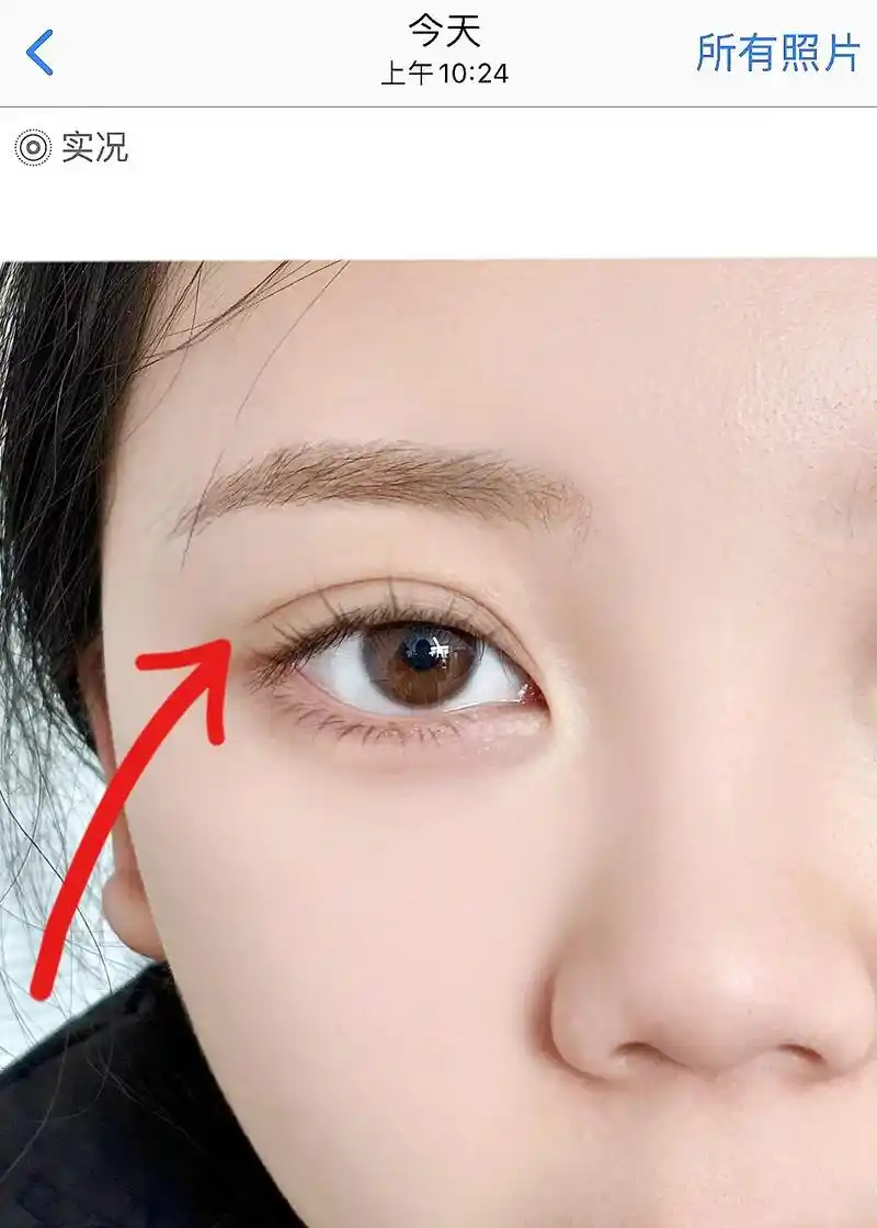 哭死!多希望做双眼皮前有人告诉我这些!