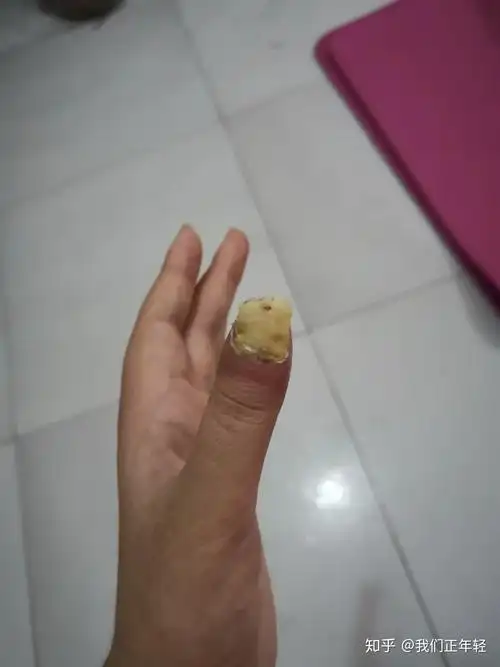 手指被砍掉一点是什么感受?