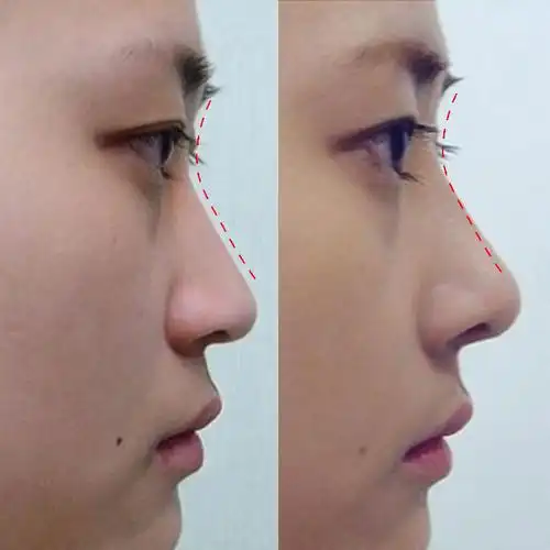 鼻梁变高的正确方法