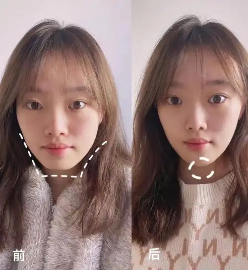 玻尿酸太适合填充下巴了