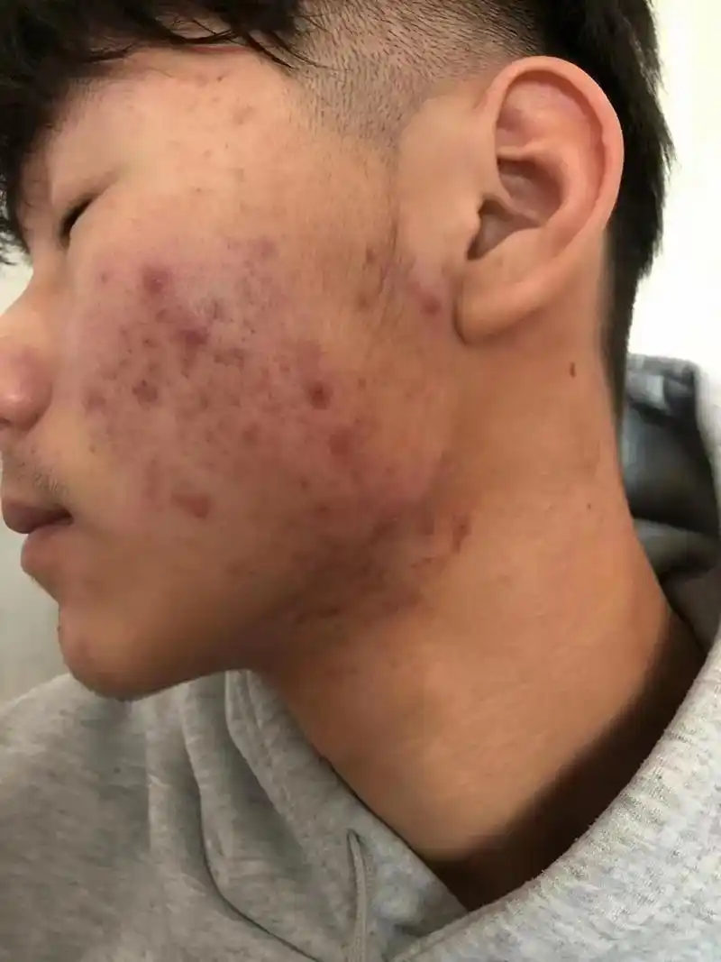 兴颜雅涵冻龄水 拯救痘痘肌,毛孔粗大,黑头粉刺,皮肤粗糙,暗 - 抖音