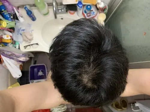 想问下这是秃顶的前兆吗?突然发现 有点害怕
