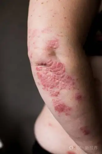 在治疗牛皮癣湿疹和其他干燥的皮肤状况时用润肤剂干片状皮肤妇女的手